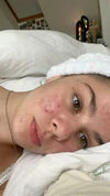 files/acne.webp
